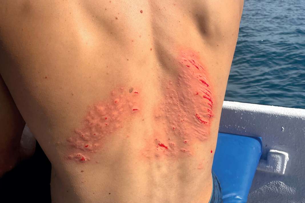 So versorgt ihr Surf-Verletzungen, um Infektionen zu vermeiden