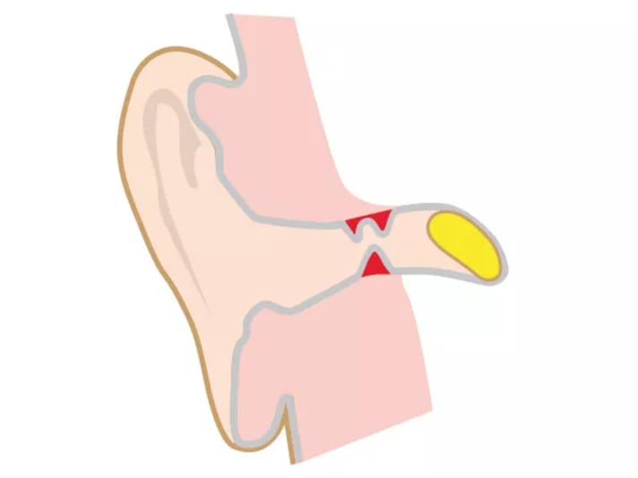 Dans le cas de l'"oreille du surfeur", des rétrécissements osseux se forment dans le conduit auditif et empêchent l'écoulement de l'eau.