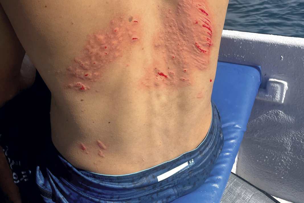Some surfers wear the so-called reef tattoo like a trophy. We show you how to properly treat minor injuries