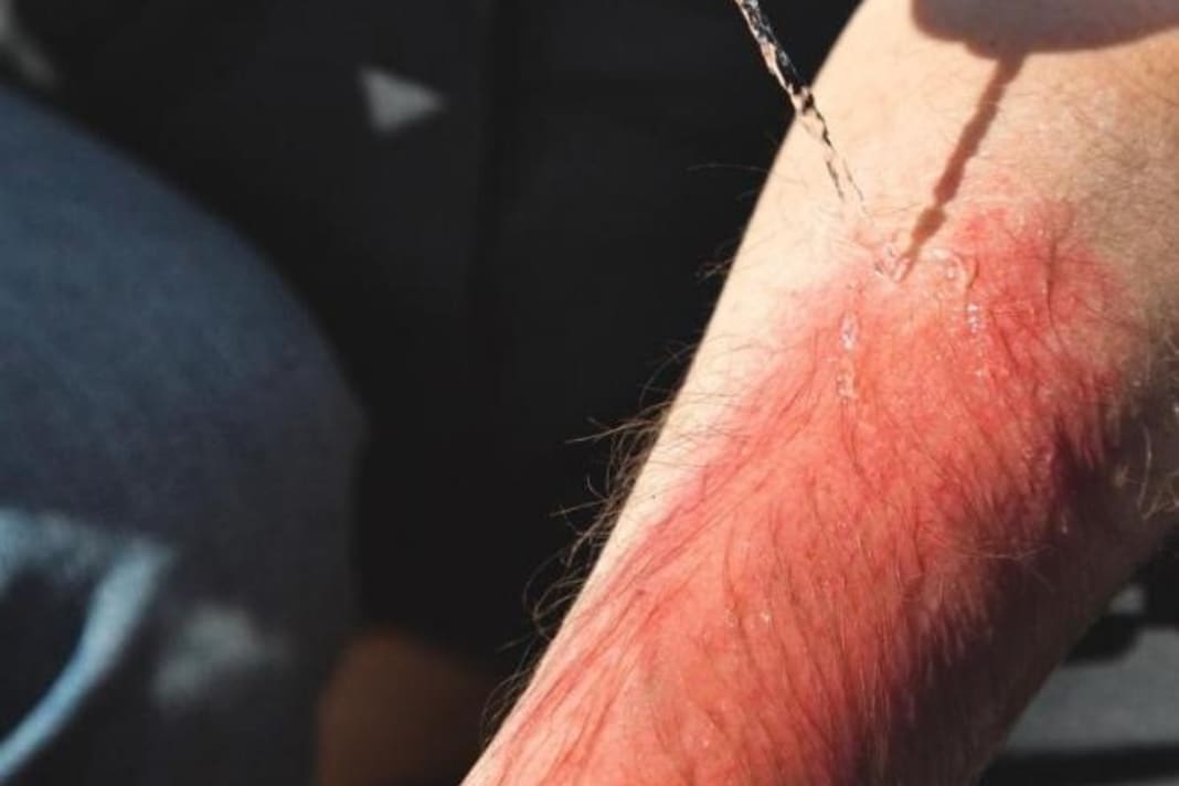 Sterilise your own hands with a disinfectant solution and wear examination gloves. Clean the burn with boiled water or a liquid specially designed for this purpose