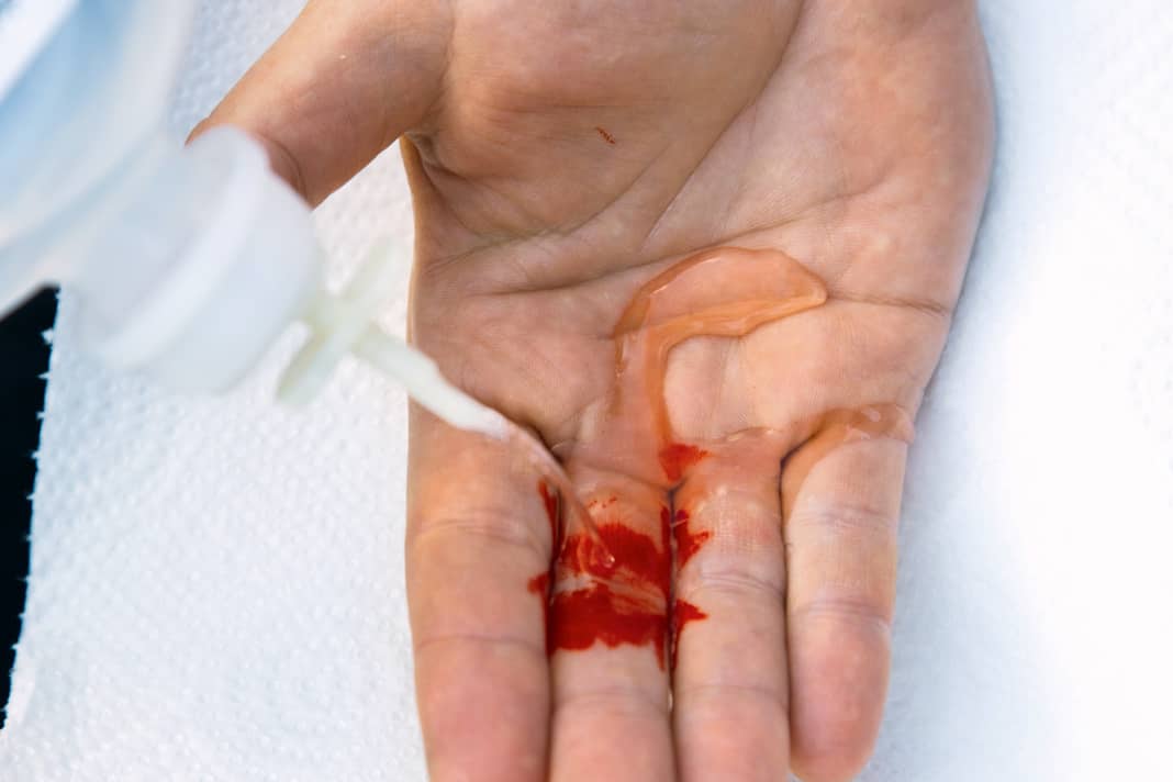 First clean an open wound with sterile water