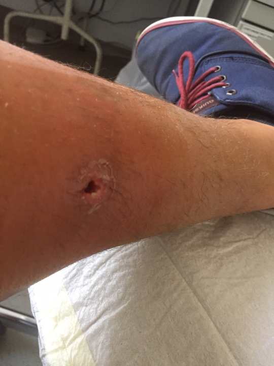   The effects of the infection