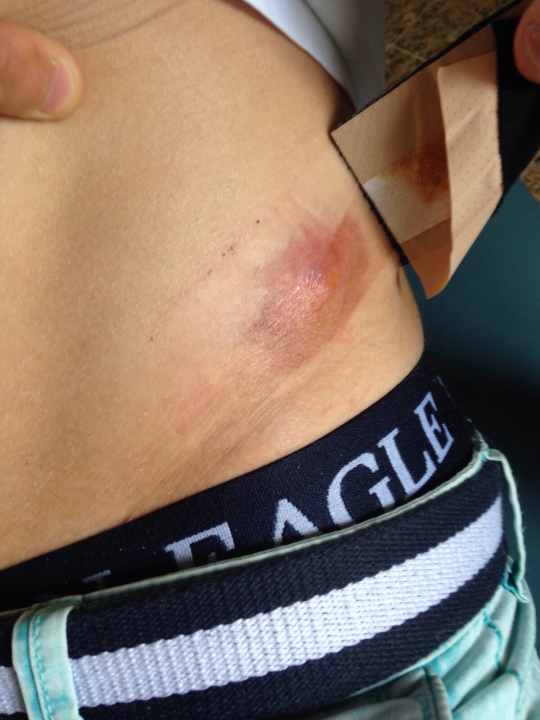   Now completely healed: the infection on the hip
