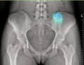 Diagnose: Knochenkrebs. Der Tumor hatte einen Teil des Beckens befallen.