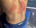 Some surfers wear the so-called reef tattoo like a trophy. We show you how to properly treat minor injuries
