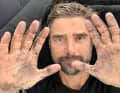 Boris Herrmann's hands bear witness to the intensive repair work of the past few days