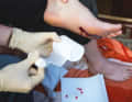 Stop the bleeding with a compress