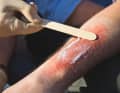 If burn blisters have formed, do not open them. Apply a thin layer of burn ointment or fat ointment to the burn, continue to pay meticulous attention to sterility and use a fresh wooden spatula