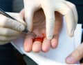 Remove splinters or other impurities as soon as possible to avoid inflammation. Then sterilise the wound again as described above