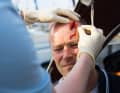 First clean the wound as described under "Cuts".