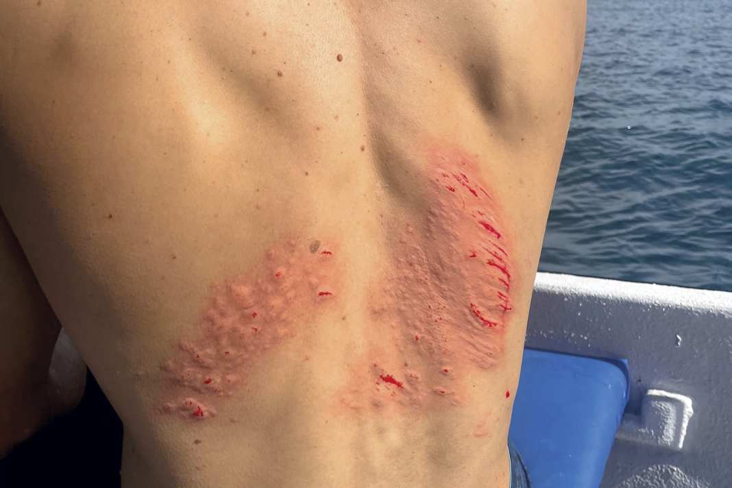 Some surfers wear the so-called reef tattoo like a trophy. We show you how to properly treat minor injuries