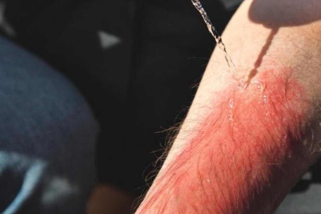 Stériliser ses propres mains avec une solution désinfectante et porter des gants d'examen. Nettoyer la brûlure avec de l'eau bouillie ou un liquide spécialement conçu à cet effet.