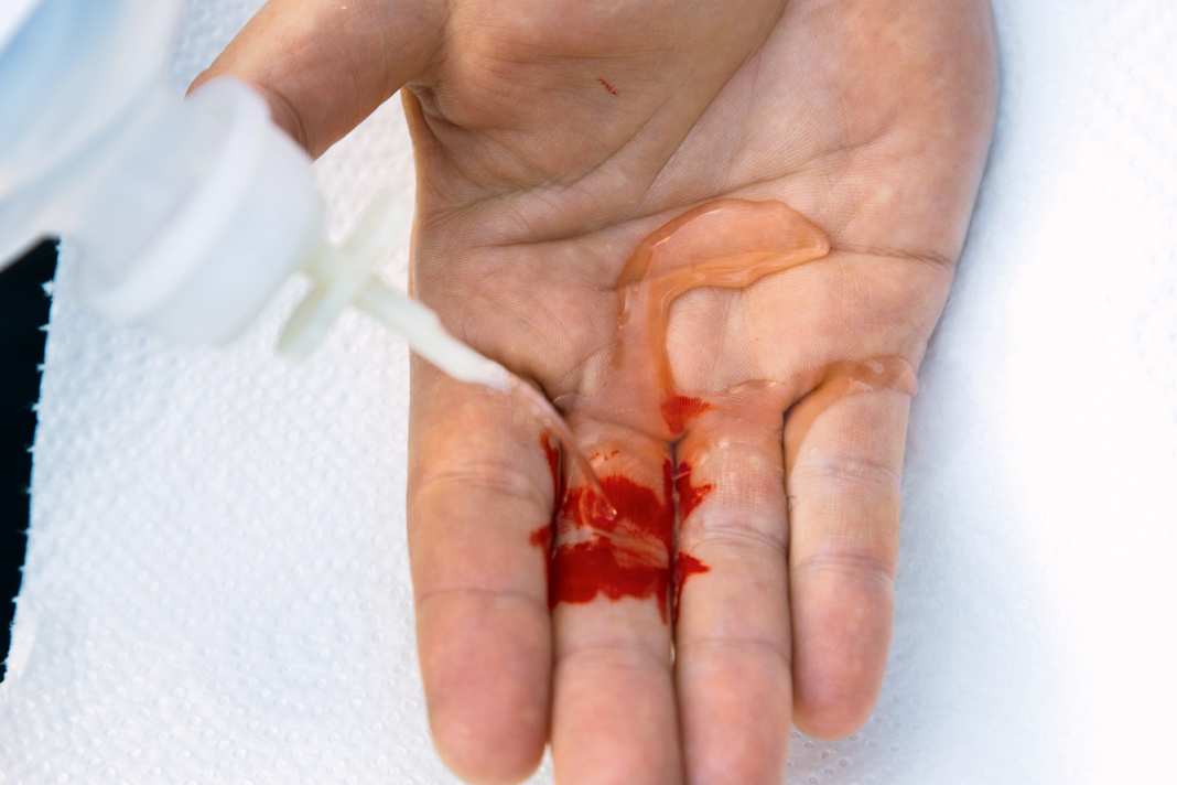 First clean an open wound with sterile water