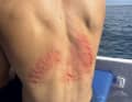 Some surfers wear the so-called reef tattoo like a trophy. We show you how to properly treat minor injuries