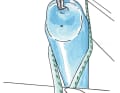 Quick and easy self-made shock absorbers.