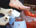 Stop the bleeding with a compress