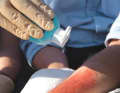 If the wound is very dirty and there is an increased risk of infection, additionally disinfect it with a non-alcoholic solution. If necessary, alcohol-based