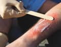 Si des cloques se sont formées, ne pas les ouvrir. Appliquer une fine couche de pommade pour brûlures ou de pommade grasse sur la brûlure, continuer à veiller scrupuleusement à la stérilité, utiliser une spatule en bois fraîche.