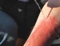 Stériliser ses propres mains avec une solution désinfectante et porter des gants d'examen. Nettoyer la brûlure avec de l'eau bouillie ou un liquide spécialement conçu à cet effet.