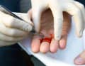 Rimuovere al più presto schegge o altre impurità per evitare infiammazioni. Quindi sterilizzare nuovamente la ferita come descritto in precedenza.