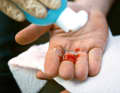 Disinfect the wound and always sterilise the required instruments.