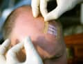 Fix the wound in the compressed position with plaster strips. If these do not stick well, apply additional tape or plasters to the ends