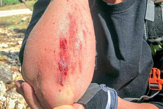 Erste Hilfe bei einer Schürfwunde