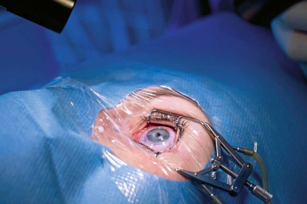 Lohnt sich das Augenlasern?