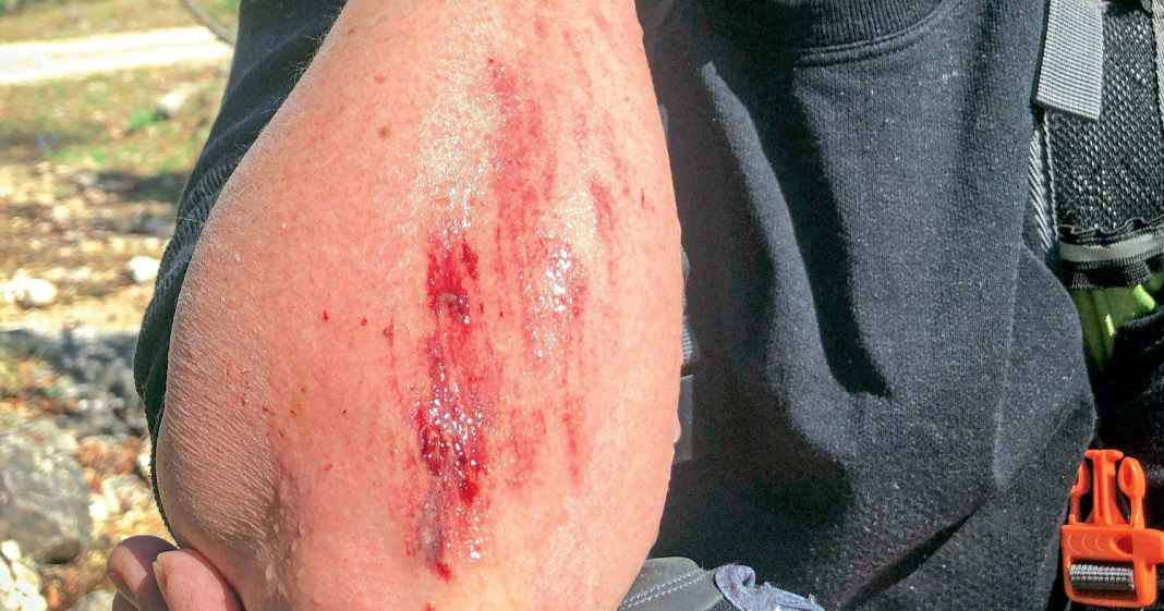 Tückische Schrammen: Erste Hilfe bei einer Schürfwunde | BIKE