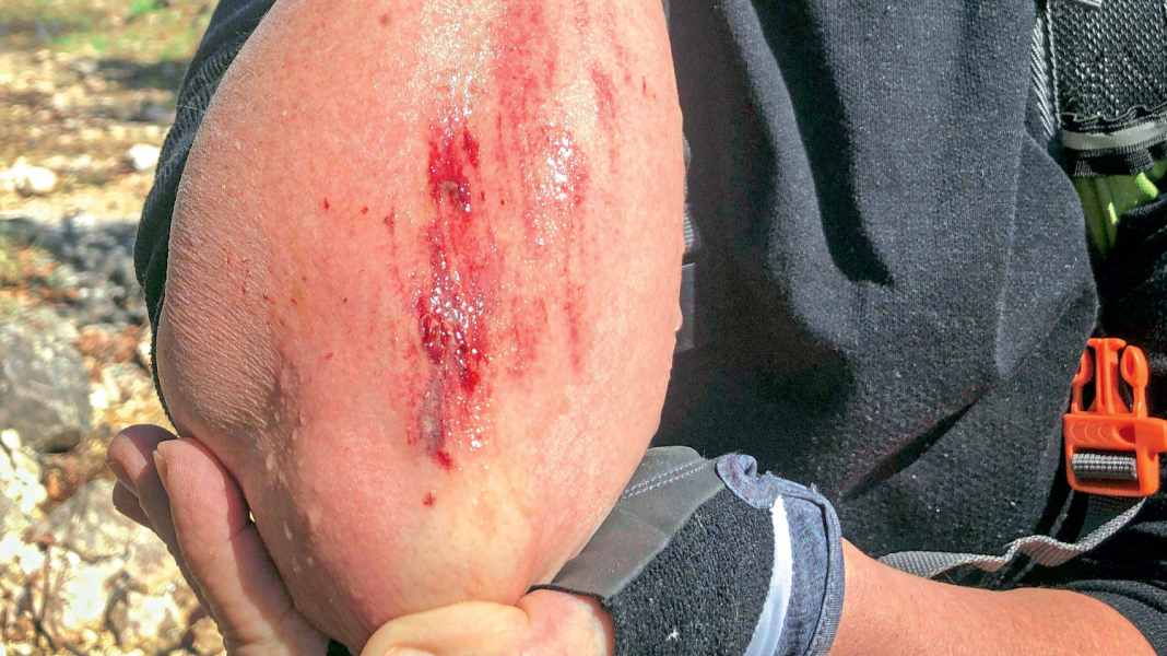 Treacherous scratches: First aid for an abrasion