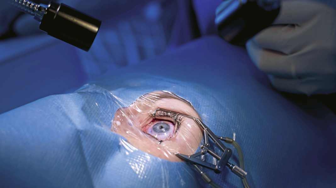 Klare Sicht: Augen-Lasern fürs Radfahren - “Würde es sofort wieder tun”