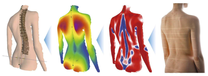 Säulenarchitektur: Eine gesunde Wirbelsäule beschreibt ein doppeltes S; mittels Röntgen oder strahlenfreier Methoden kann man Fehlstellungen sichtbar machen.