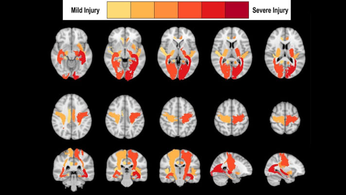 Ergebnisse der neuen individualisierten Bildgebung. In einem ersten Schritt werden mit der neuen Methode die betroffenen Systeme farbig kodiert aufgezeigt. Gering veränderte Bereiche werden in gelb angezeigt und je ausgeprägter die Veränderung ist, desto dunkler rot wird das betroffene System der Anatomie abgebildet.
