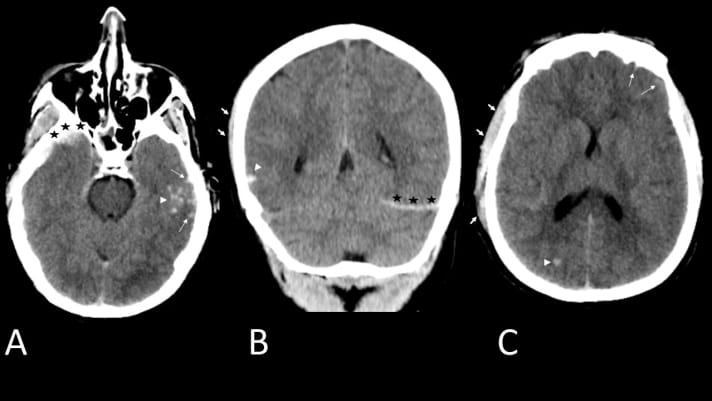 Computertomogramm (CT - ohne Kontrastmittel) des Kopfes eines jungen Mannes nach Schädel-Hirn-Trauma. Man sieht einen Bluterguss (dicke Pfeile in B und C) in und unter der Haut an der Schläfe. Im Schädel (unterhalb der schwarzen Sterne in A und B) findet sich ein Bluterguss zwischen Gehirn und Gehirnhaut. Man sieht auch Blut zwischen den Hirnfurchen (schlanke Pfeile in A und C) und im Hirngewebe selbst (Pfeilspitzen in A-C).