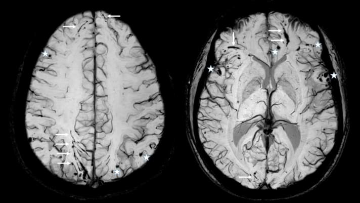 MRI of a traumatic brain injury using the susceptibility-weighted technique (SWI): In addition to the punctiform haemorrhages in the brain tissue (white stars), further lacerations (so-called shear injuries, white arrows) can be found, which may only be found using this technique and even years after an accident. Corresponding complaints arise where they occur. Due to the reported course of the accident, the craniocerebral trauma was only categorised as "mild" - no MRI or CT scan was therefore performed on this patient.