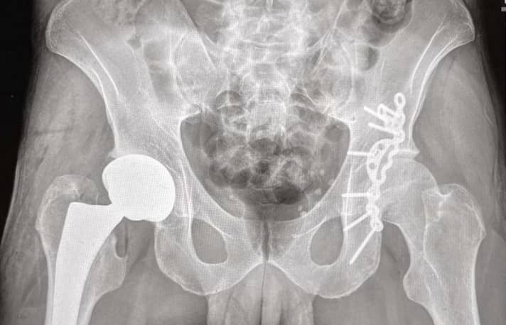 Schrauben und Gelenke: Röntgen­aufnahme von Stefans Hüfte.