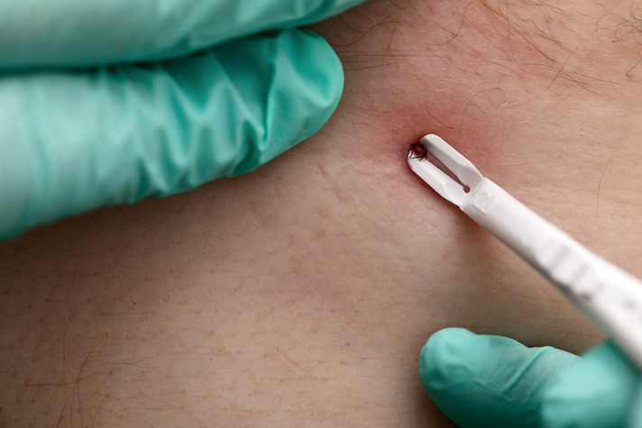 "The aim is to pinch off the tick as far forward as possible - i.e. close to the skin," says expert Jelinek.
