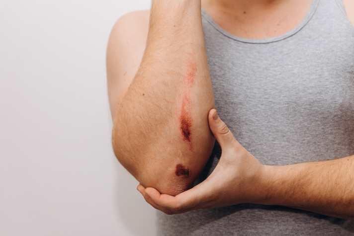 Sturz im Wald? Schon kleinere Wunden als diese können zu einer Tetanus-Infektion führen.