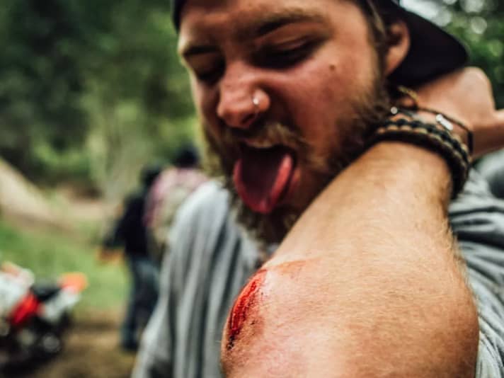 OUCH! Cruz Fest: There are always injuries, including to the elbow.