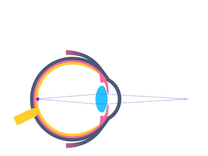 If the refractive power of the cornea and lens match the length of the eyeball, a sharp image is produced