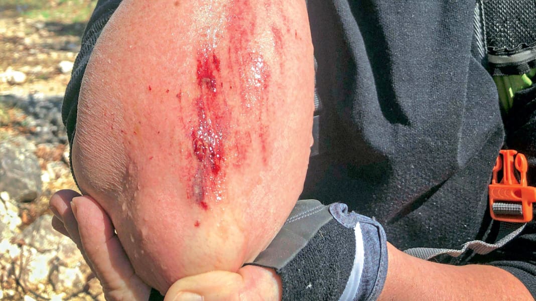 Tückische Schrammen: Erste Hilfe bei einer Schürfwunde