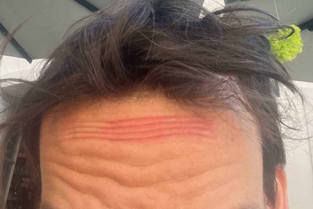 Est-ce à cause du casque ou de la lampe frontale ? Dans tous les cas, c'est agaçant. J'ai une marque de pression sur le front.