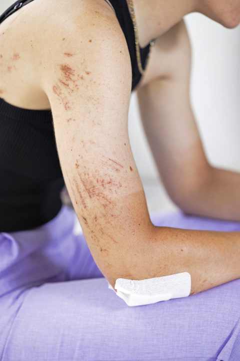 Erfahrungen: Mit der ihr eigenen Zielstrebigkeit verbucht Rosa Klöser Sturzverletzungen als Ereignisse, aus denen sie für die Zukunft lernen kann