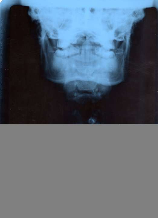   Marcus Klausmann also had to take a beating in his career. He came within a hair's breadth of being paralysed when he broke his neck.