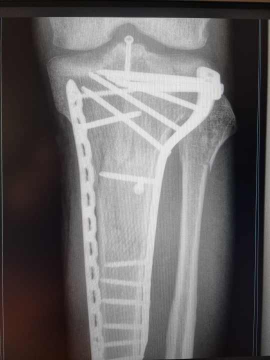 Quite a lot going on in BIKE editor Jan Timmermann's knee. After a fracture of the tibial plateau, his leg lacked extension and flexion for a long time. Cycling was only possible with a shortened crank.