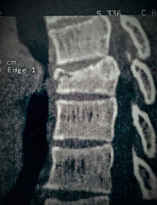 Almost ended up in a wheelchair: Fabien breaks his back in 2014.