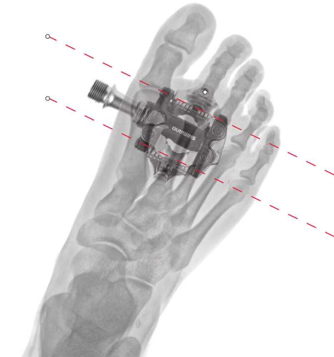   Richtig montierte SPD Cleats verhindern die Fehlstellung