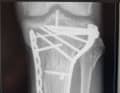 Quite a lot going on in BIKE editor Jan Timmermann's knee. After a fracture of the tibial plateau, his leg lacked extension and flexion for a long time. Cycling was only possible with a shortened crank.