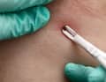 "The aim is to pinch off the tick as far forward as possible - i.e. close to the skin," says expert Jelinek.