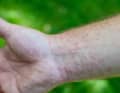 The hollow hairs of the spinner moths break and release a protein-based toxin. This can lead to allergic reactions, conjunctivitis and chemical urticaria. Yet the fully-grown moth is a peaceful creature.